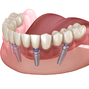 Treatment - Family Dental Care Centre