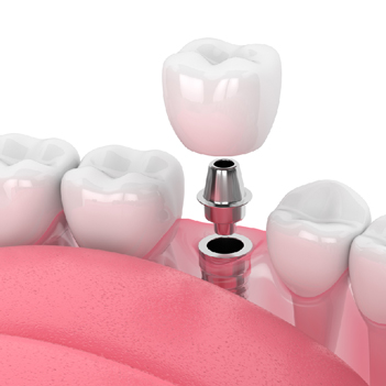 Treatment - Family Dental Care Centre