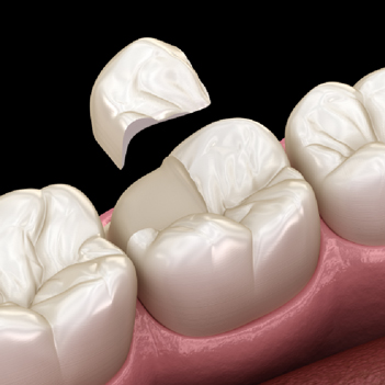 Treatment - Family Dental Care Centre